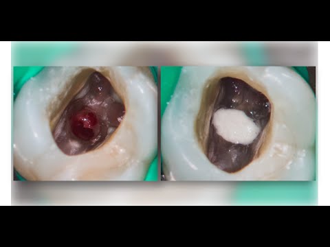 Repair of a iatrogenic perforation of the pulp chamber floor of a maxillary molar