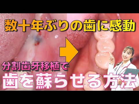 生命歯学科 【歯牙移植症例集】入れ歯も使えず数十年噛めなかった奥歯が蘇る？分割歯牙移植による奥歯の再建🦷快適に噛める歯牙移植の方法を大公開❗️歯を抜く前にインプラントを入れる前に歯の移植を検討してみてください‼️