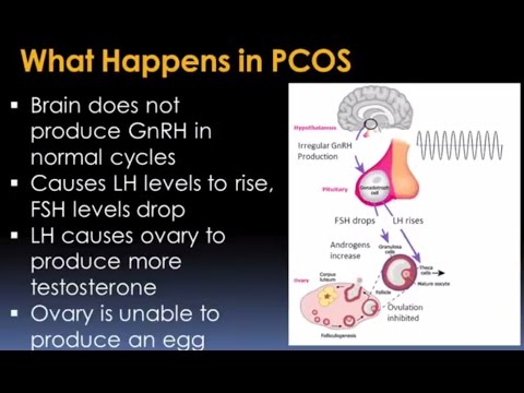 Understanding Polycystic Ovary Syndrome Video – Brigham and Women’s Hospital