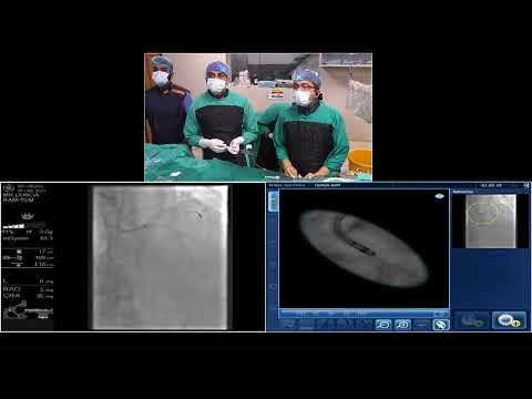 DR KUNAL MAHAJAN HHI MANDI LIVE CASE DOUBLE BIFURCATION LMCA AND LAD/D1