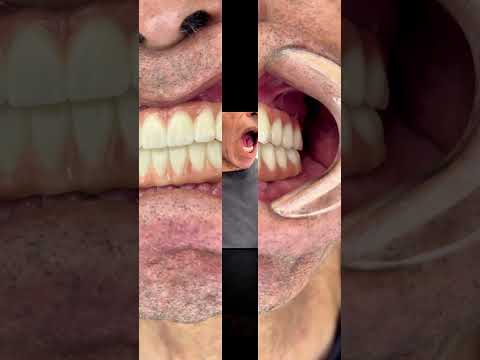 Allon5 Implant Denture