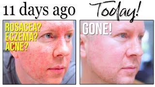 It You Have Rosacea / Acne / Inflamed Red Face This Skincare Routine Will Work FAST!