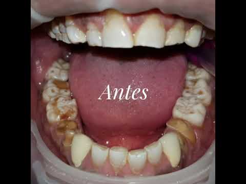 Cosmetic dentistry in Cartagena, Colombia by dentist Tarsys Loayza Roys