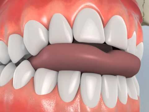 Anterior OpenBite (Tongue-Trainer) Close Up