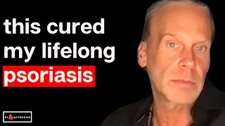 Finding Out The Truth About Psoriasis After 30 Years of Suffering | Stephen Lashbrook