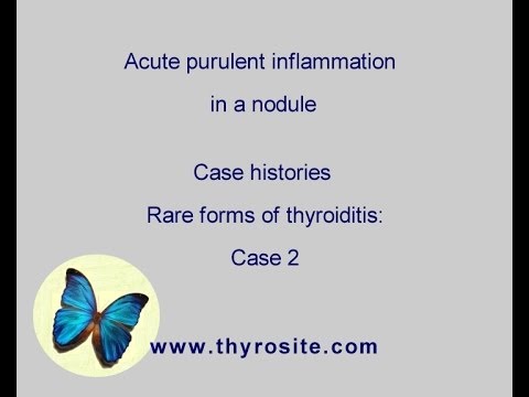Rare forms of thyroiditis - case 2: Acute thyroiditis - YouTube
