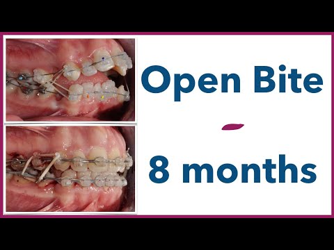 Orthodontic Open Bite Tip: 🎢rollercoaster effect to your advantage