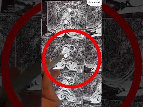 Spinal tumour : Meningioma: what is it ?How does MRI look pre and post surgery