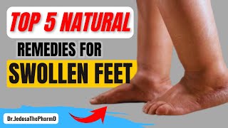 5 Natural Remedies to Reduce Swollen Feet and Ankles Fast