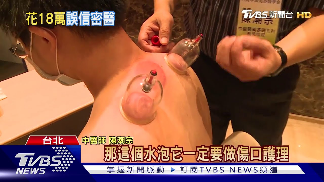 拔罐禁忌！避開心臟、拔太久　憂起水泡感染