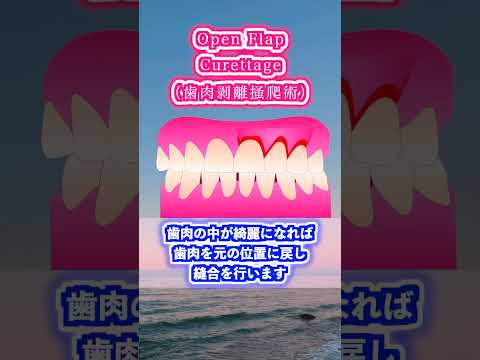 生命歯学科 歯周外科手術　Open Flap Curettage法について解説します！　#shorts  #歯周外科　＃歯周病　＃歯を抜かない　＃歯を残す #歯を抜かない #dentist #歯科 #前歯