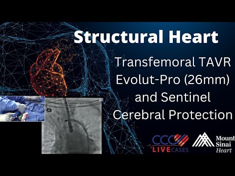 Transfemoral TAVR Evolut-Pro (26mm) and Sentinel Cerebral Protection - Structural Live July 2017