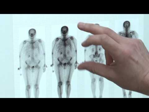 Chirurgia del cancro della prostata a Mosca Come trattare la prostata senza farmaci