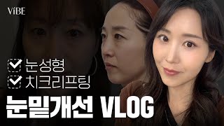 [성형 Vlog] 다크서클, 눈밑주름, 팔자주름 고민 끝! 중안면거상 + 하안검 + 자연유착 쌍꺼풀 3개월 변화✨
