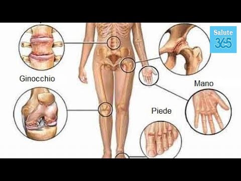 Contrattura del forum spalla Che cosa è sinovite dellarticolazione e la cura