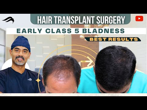 Hair Transplant In Bangalore | Best Surgeon Cost &...