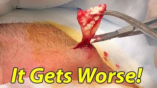 Popping Huge Cyst - Best Cyst of All Time?