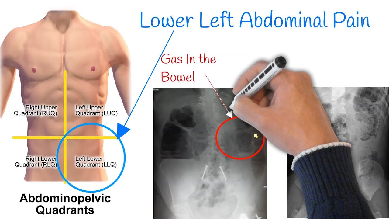 Lower Left Abdomen Pain: Common Causes and Relief Options, Beauty Vigour