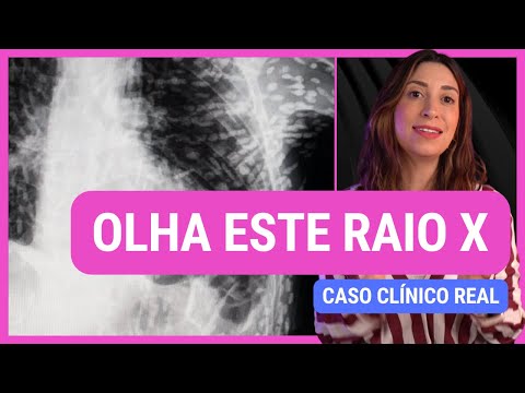 REAL CLINICAL CASE: CYSTICERCOSIS! Anatomy etc. #cysticercosis