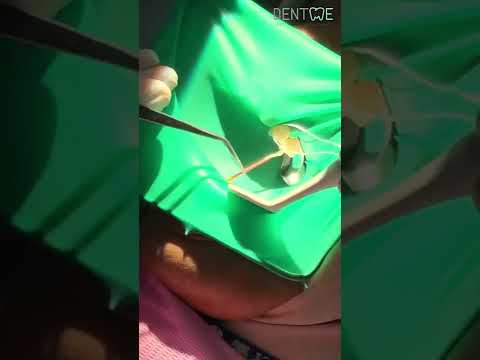 Perawatan Saluran Akar in One Day Treatment