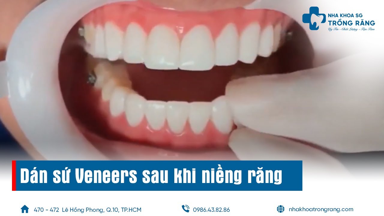 Dán sứ veneer sau khi tháo niềng răng | Veneer Emax Press