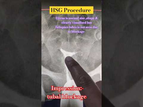 HSG procedure || RadiologyStudy7 #radiographers #xray #hsg #radiology #fallopiantubeblockage