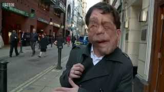 The Ugly Face of Disability Hate Crime