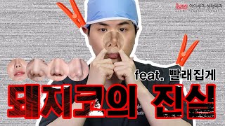 코끝연골묶기 찝힌코, 돼지코의 원인이라고?