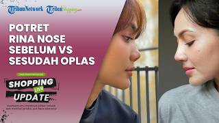 Potret Transformasi Rina Nose Sebelum dan Sesudah Operasi Plastik Hidung, Disebut Bikin Pangling