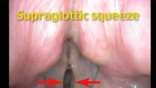 Muscle Tension Dysphonia