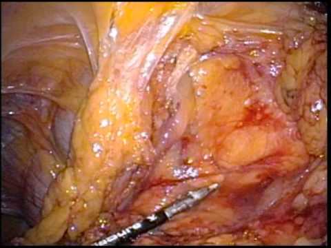 Minimally Invasive Hemicolon Excision-Radical Approach