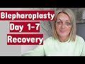 My Eye Surgery (Upper&Lower blepharoplasty) / Day 1-7 Recovery