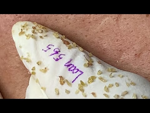 Loan Nguyen Acne Treatment (#103)