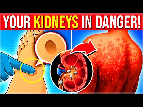 11 High OXALATE Foods That Are Destroying Your Unhealthy KIDNEYS You Must Limit