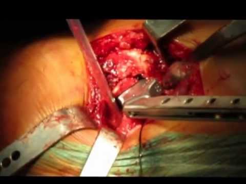 Al di dilatazione scricchiolio Dolore al collo dopo lanestesia epidurale