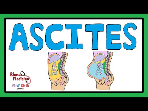 ASZIT - Serum-Aszites-Albumin-Gradient (SAAG) | Aszites-Pathophysiologie | Aszites-Ursachen