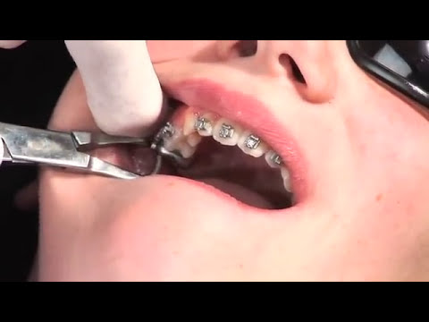 AdvanSync2 - Treat Class II Cases