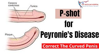 P shot for Peyronie's disease | Treatment for your curved penis | Priapus shot | PRP therapy