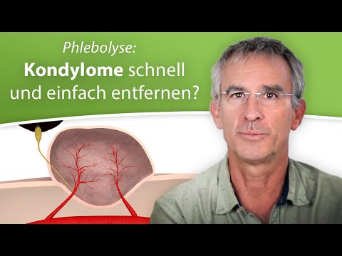 Genitalwarzen, Feigwarzen und Kondylome - Schonende Verödung der Blutgefäße durch Phlebolyse
