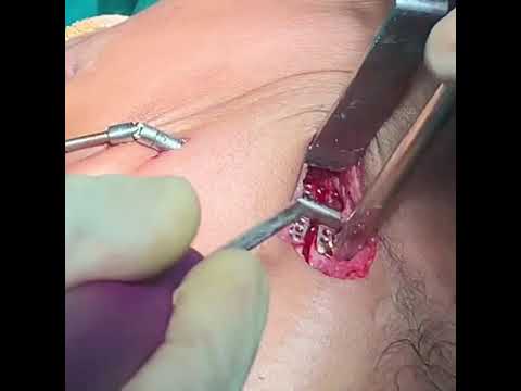 Talk On Mandibular Distraction Osteogenesis