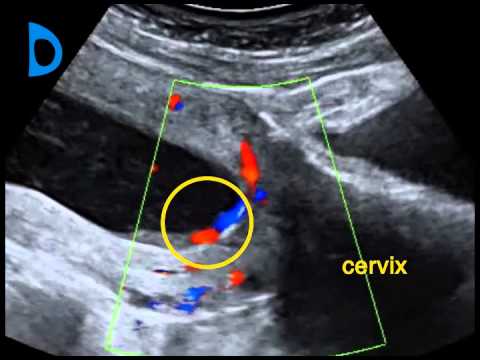 Fetal Medicine Foundation - vasa previa