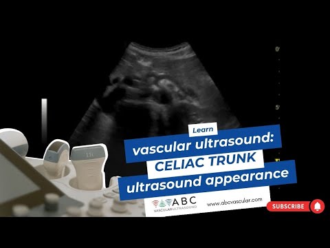 Celiac Trunk ultrasound appearance: vascular ultrasound learning