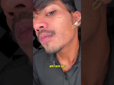 Day 31 Of Using Man Matters Minoxidil 5% For Beard Growth 😉 #beardgrowth #minoxidilresult #shorts