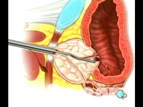 Spezies Prostatamassager Prostatakrebs Knochenmetastasen Behandlung von Volksmittel