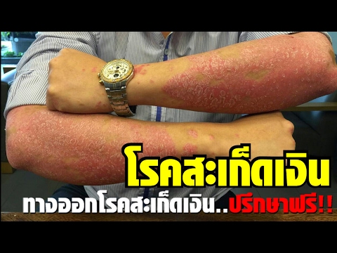 กลากอยู่บนเท้าของการรักษาของเธอ กลากแห้งบนมือชุ่มชื้น