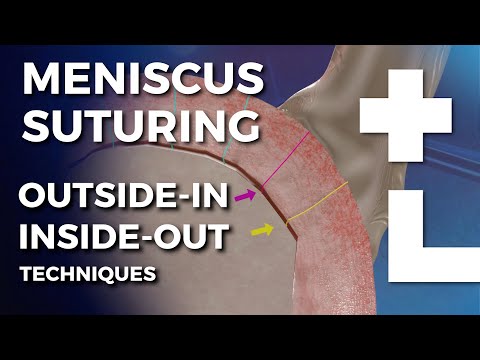 Arthroscopic Meniscus Repair