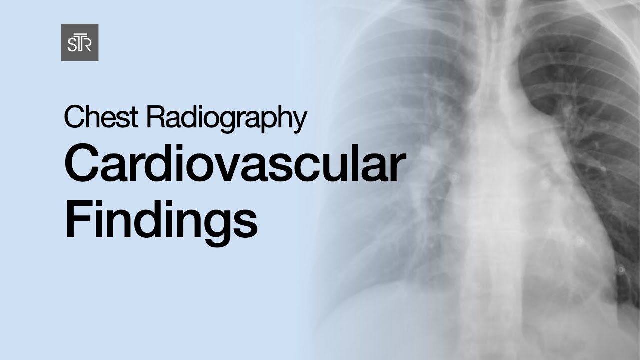 Chest Radiography: Cardiovascular Findings