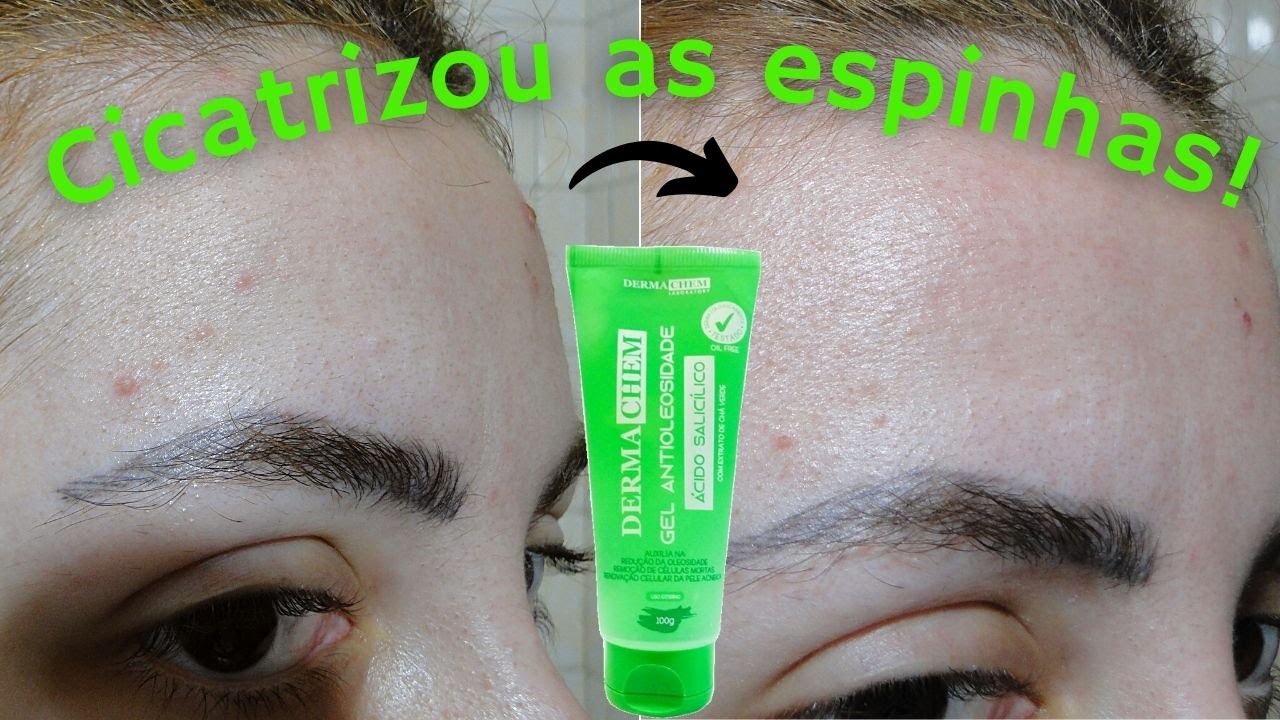 GEL ANTIOLEOSIDADE (DERMACHEM)