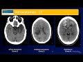 Emergency Imaging of Brain Tumors: Astrocytomas