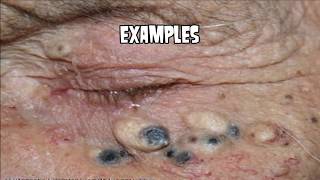 Black head, Blackhead, & More B-heads! Black Heads!!